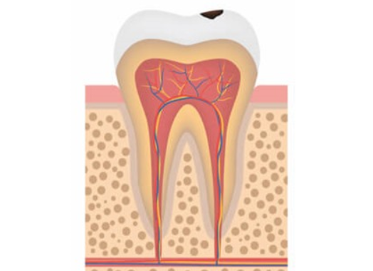 Лечение кариеса