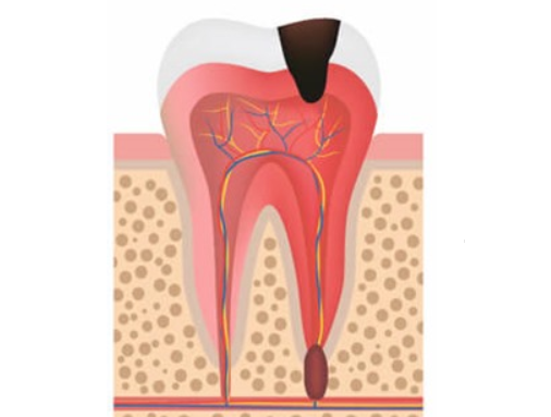 Лечение периодонтита